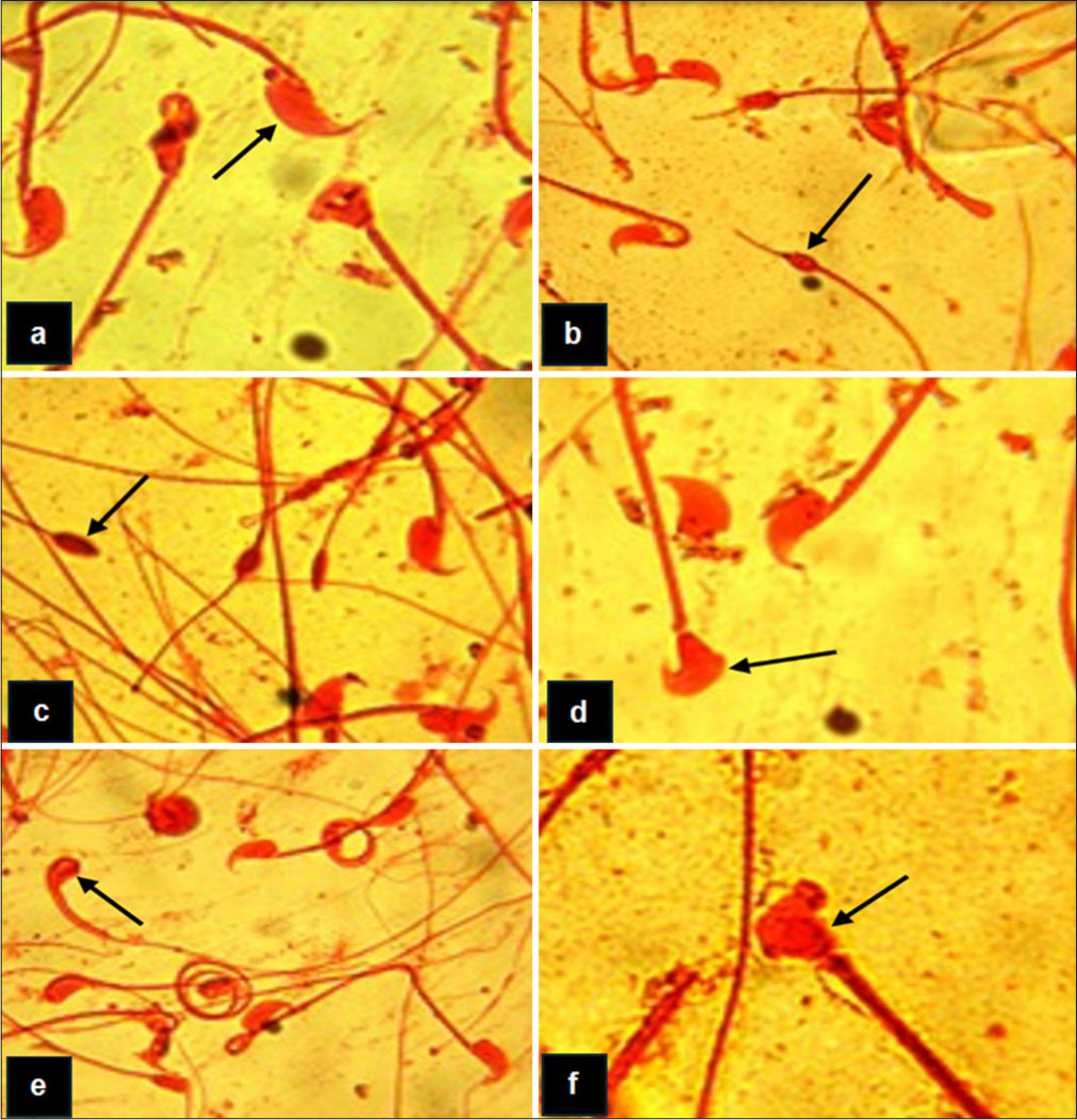 Major sperm head morphology anomalies observed. (a) Spermatozoon (arrowed) exhibiting normal sperm head morphology, (b) Spermatozoon (arrowed) showing pin-head anomaly, (c) Spermatozoon showing a knobbed (arrowed) anomaly, (d) Spermatozoon (arrowed) exhibiting an amorphous head anomaly, (e) Spermatozoon (arrowed) illustrating the knobbed head anomaly, (f) Spermatozoon (arrowed) illustrating the hammer-head anomaly.